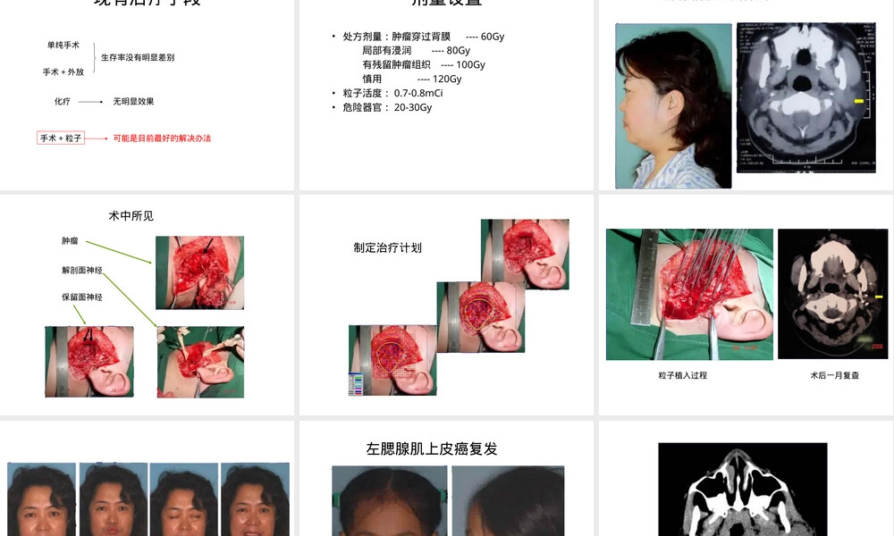 粒子植入演示讲解PPT课件,粒子植入治疗技术演示PPT课件.ppt