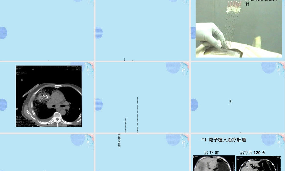放射性粒子植入治疗肿瘤PPT课件.ppt