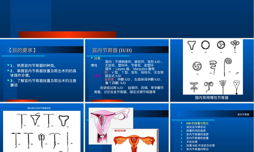 宫内节育器放置与取出术教学PPT课件.ppt