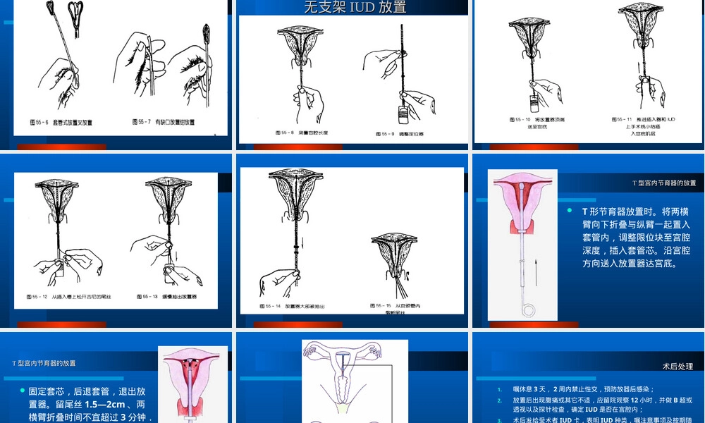 宫内节育器放置与取出术教学PPT课件.ppt