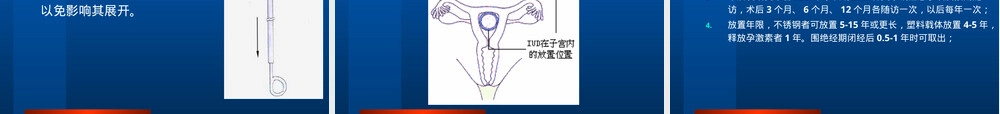 宫内节育器放置与取出术教学PPT课件.ppt