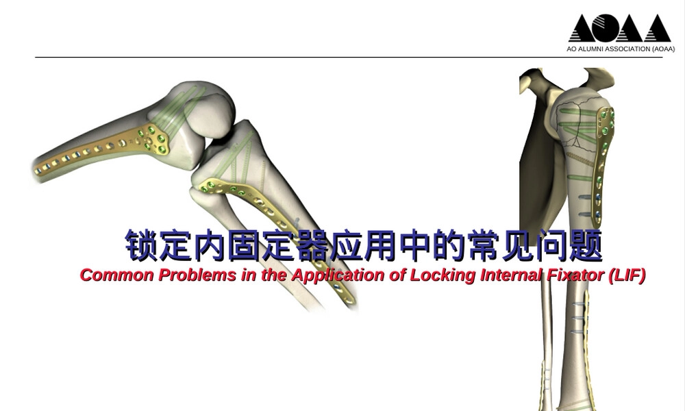 锁定内固定器应用及取出常见问题PPT课件.ppt