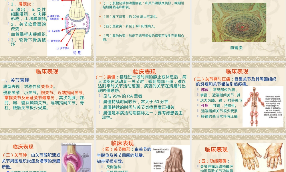类风湿关节炎诊疗PPT课件.ppt