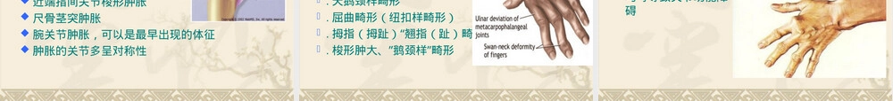 类风湿关节炎诊疗PPT课件.ppt
